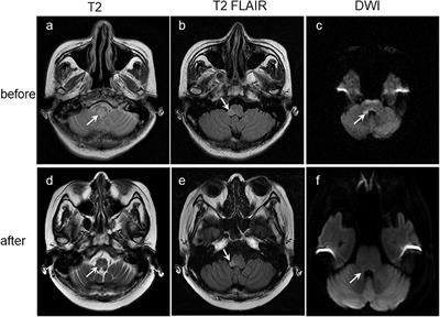 Cytomegalovirus Infection in an Adult Patient With Neuromyelitis Optica and Acute Hemorrhagic Rectal Ulcer: Case Report and Literature Review